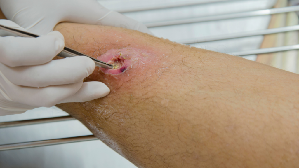 wound culture analysis